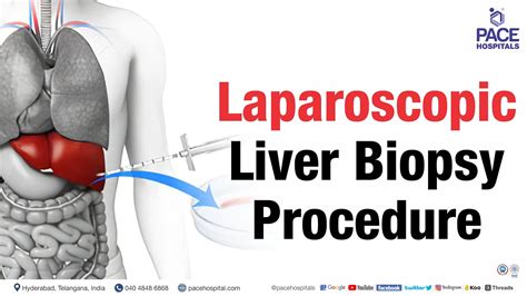 Laparoscopic Liver Biopsy Procedure Shortvideo Liverbiopsy Youtube