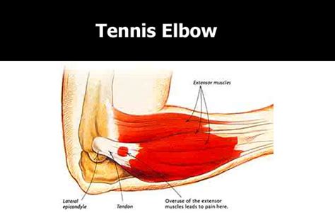 Forearm Pain Near Elbow