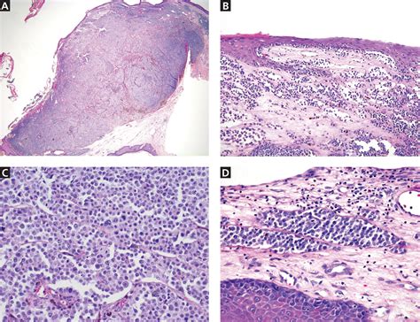 Polypoid Melanoma Mistaken For Verruca Vulgaris Cleveland Clinic