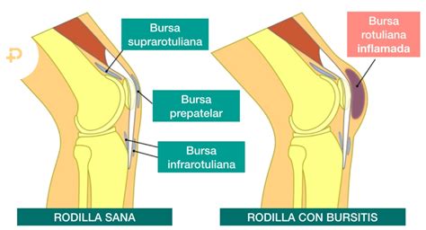 Cu Nto Dura Una Bursitis De Rodilla Omimed