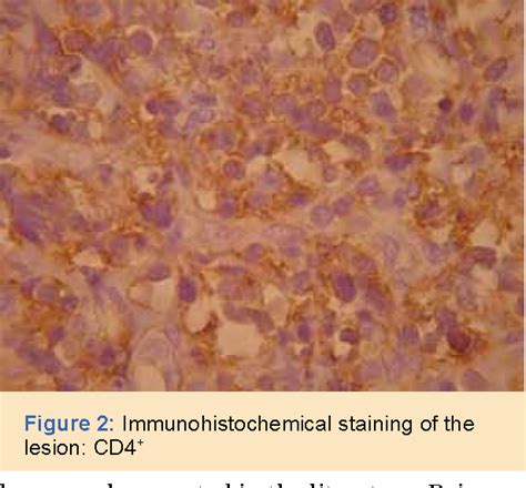 Figure 2 From Primary Cutaneous CD4 Positive Small Medium Sized