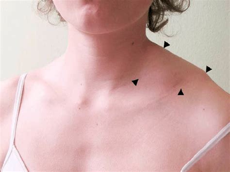 Lump On Neck Near Collar Bone