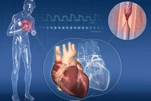 Cardiopatia Ischemica Cronica Definizione Sintomi Conseguenze