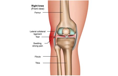 Posterolateral Corner SportsMD