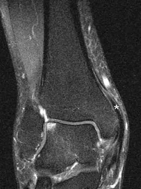 Preoperative Mri Frontal Plane The Lateral Talar Osteochondral