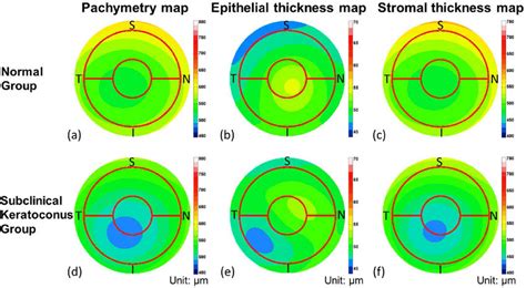 Average Pachymetric Corneal Epithelial And Stromal Thickness Maps Of