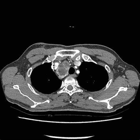 A Case Of Right Paratracheal Ectopic Thyroid Mimicking Metastasis On