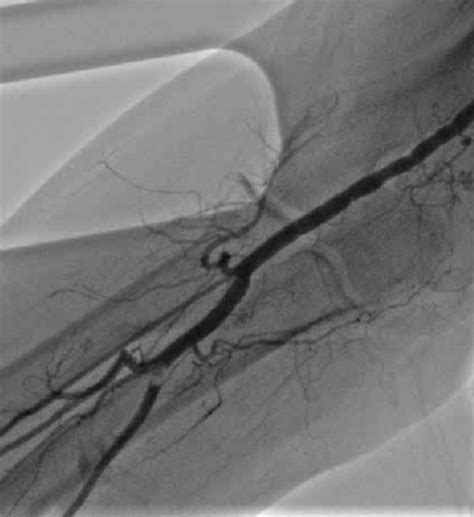 A Cine Angiography Depicting A Filling Defect In The Ulnar Artery The Download Scientific