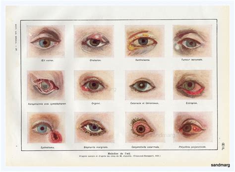 French Chart of Eye Diseases 1940s