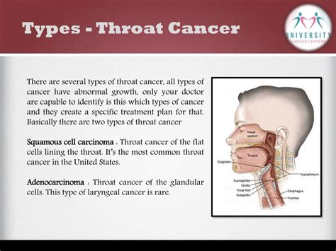 Understanding Throat Cancer Types Treatments And Preventions Nbkomputer