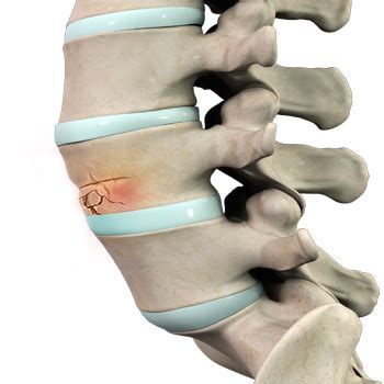 Vertebral Compression Fracture | Seacoast Orthopedics & Sports Medicine ...