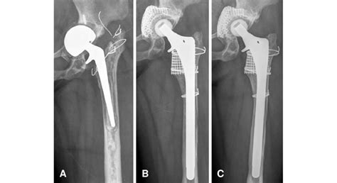 A 35 Year Old Female With Paprosky Type Iiia Bone Defect In Her Left Download Scientific