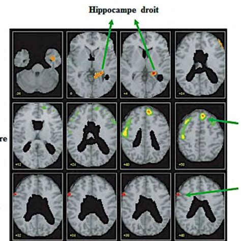 R Sultats D Une Tude En Tomographie Par Missions De Positions Tep