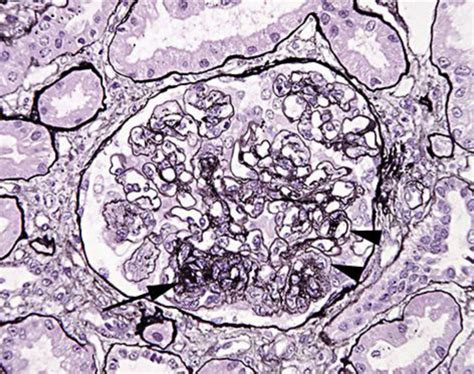 PAS Silver Stain Of A Representative Glomerulus The Renal Biopsy