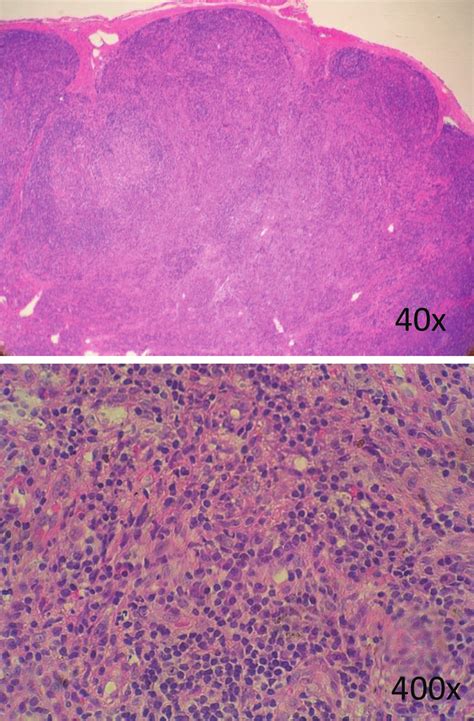 Inguinal Lymph Node Biopsy Histology Section By Hematoxylin And Eosin