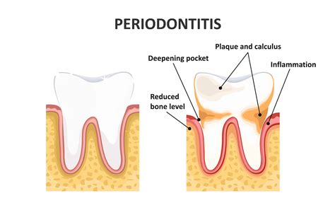 Periodontitis Treatment