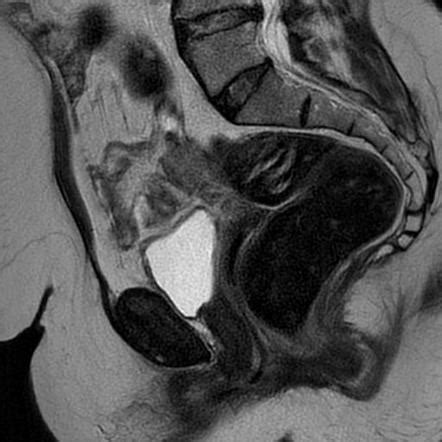 Submucosal Uterine Leiomyoma Image Radiopaedia Org