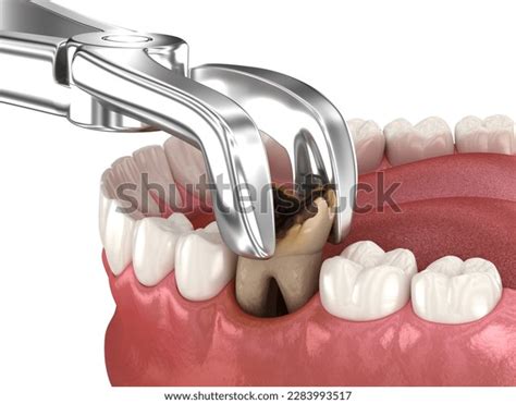 Extraction Molar Tooth Damaged By Caries Stock Illustration 2283993517 ...