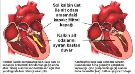 Kalp Kası Hastalıkları Belirtileri ve Tedavisi