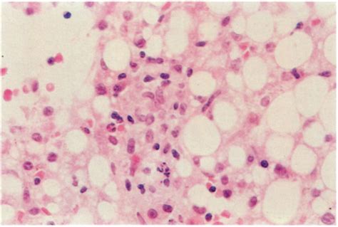 Pathology Of Brucellosis A Review Of 88 Biopsies Annals Of Saudi Medicine