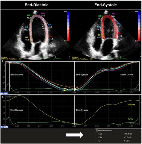 Frontiers Left Ventricular Systolic Function In Subjects Conceived