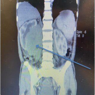 a. Hypo-enhancing mass located on the medial aspect of the right kidney... | Download Scientific ...