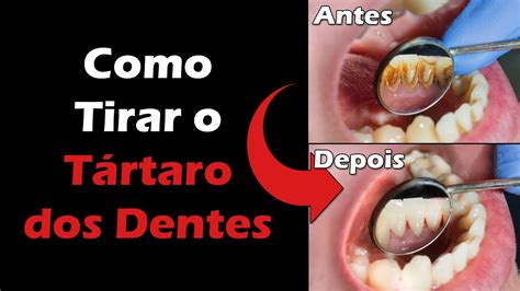 Descubra Como Tirar T Rtaro Dos Dentes E Evitar A Periodontite