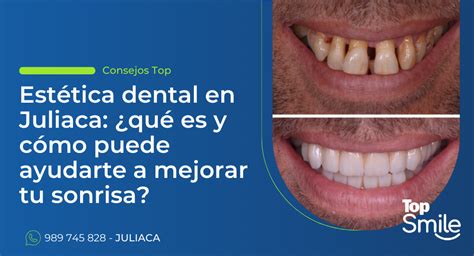 Est Tica Dental En Juliaca Qu Es Y C Mo Puede Ayudarte A Mejorar Tu