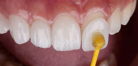 Faccette Dentali Cosa Sono E Come Funzionano Dentalicum