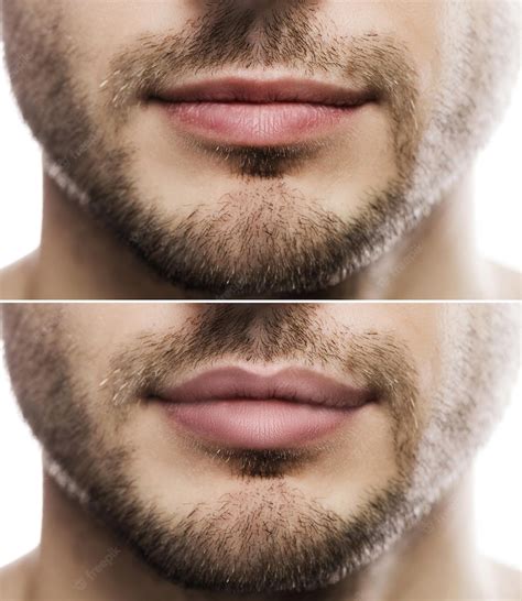 Premium Photo Result Of Lip Augmentation Male Lips Before And After Filler Injection