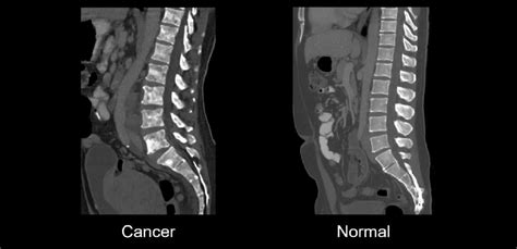 Abdominal Ct Bones • Litfl • Radiology Library