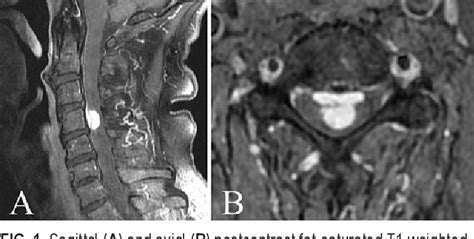 Figure 1 From Cervical Corpectomy For Resection Of Ventral