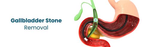 Gallstone Removal Options: Medications, Risks & Recovery