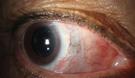 When Scleritis Is Infectious