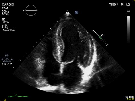 ¿qué Es Una Ecocardiografía Doppler Color Jesus De La Hera