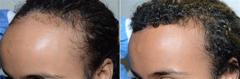 Hair Transplants For Women Photos Miami Fl Patient60004