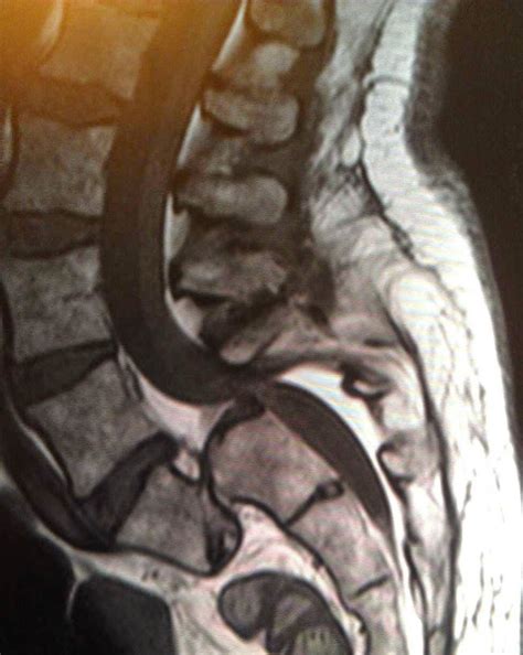 MRI Of Bulging Disc Lower Lumbar