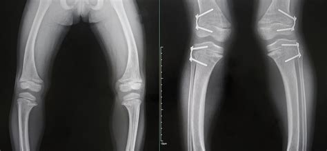 Neocate and Rickets Disease - Select Justice