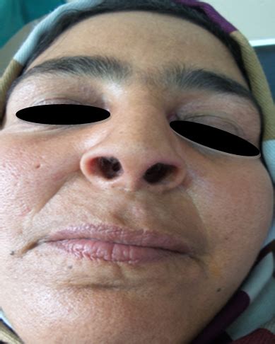 Postinflammatory Cutis Laxa A Case Report