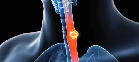 esophagus disease dr sonambekar hospital