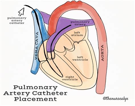 Pa Catheter Basics Criticalcarenow