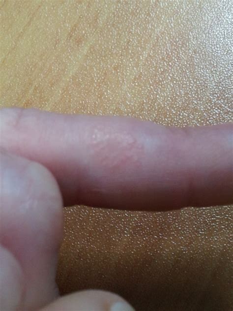 Skin Rashes On Fingers