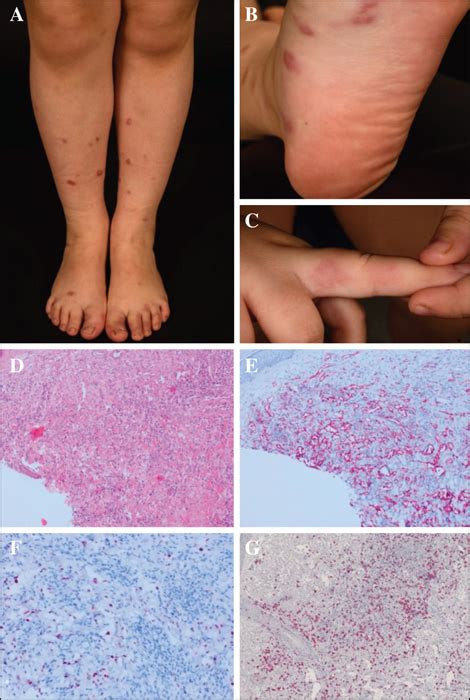 Jle European Journal Of Dermatology Disseminated Classic Kaposi