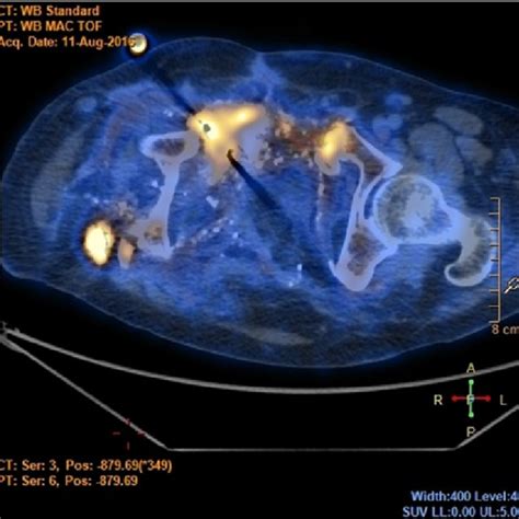 Fdg Pet Ct Scan Cross Section Of The Pelvis Before Administration Of