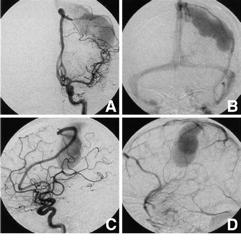 Left Internal Carotid Artery Angiograms Anteroposterior A B And