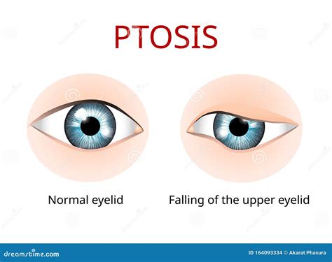 Ptosis Van Het Ooglid Anatomie Van De Oogziekte Anatomie Van De