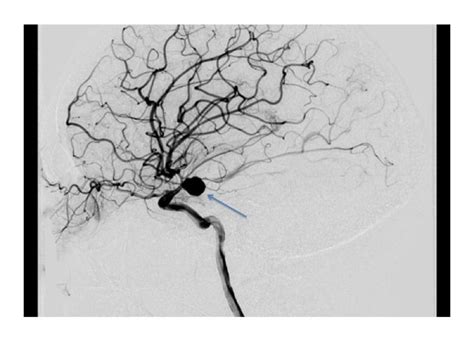 Posterior Communicating Artery Aneurysm in 20-year-old Female with ...