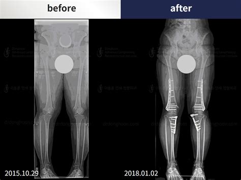 Recurrent Patella Dislocation Recurrent Patella Dislocation