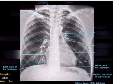 PA chest X-ray Diagram | Quizlet