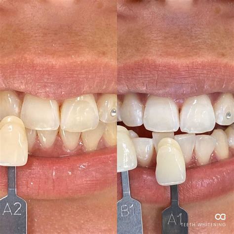 Cosmetic Dentistry Gold Coast Before And After Oasis Dental Studio